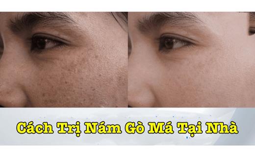 Cách Trị Nám Gò Má Tại Nhà