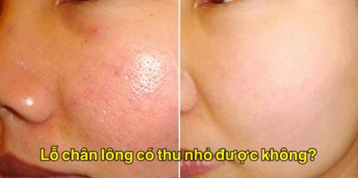 Lỗ chân lông có thu nhỏ được không?