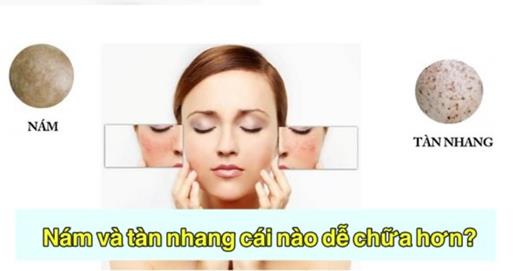 Nám và tàn nhang cái nào dễ chữa hơn?