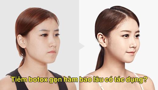 Tiêm botox gọn hàm bao lâu có tác dụng?