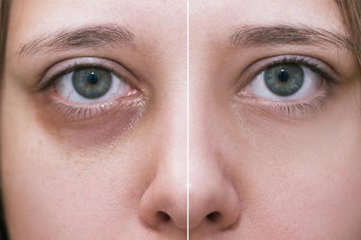 Tiêm đầy hốc mắt có nguy hiểm không?