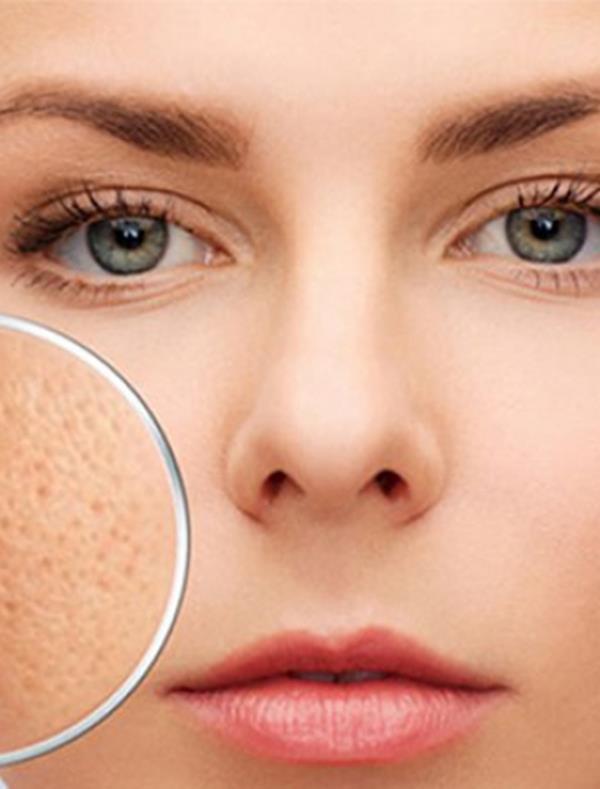 Điều Trị Sẹo Rỗ