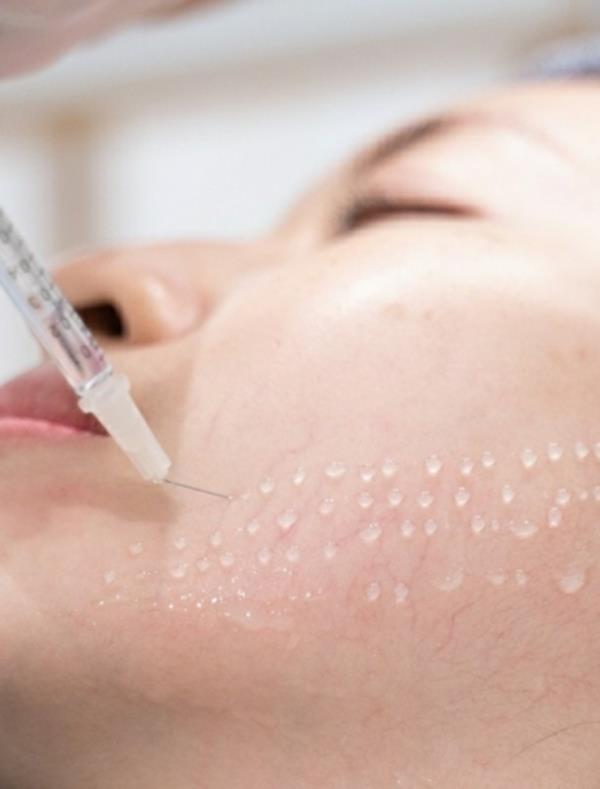 Meso Căng Bóng Độc Quyền