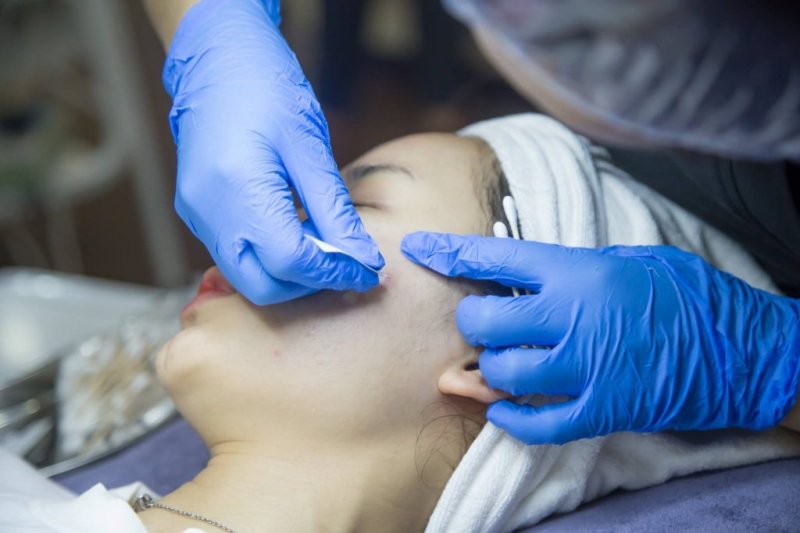 Lấy nhân mụn theo tiêu chuẩn y khoa