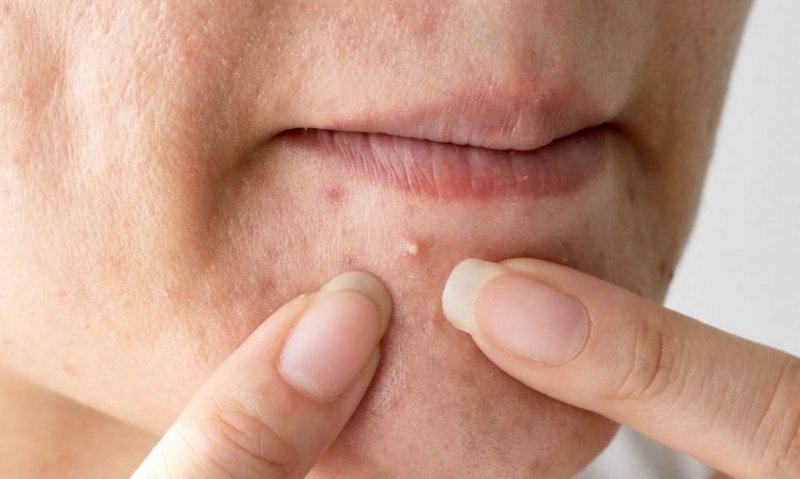 Nặn mụn đầu trắng