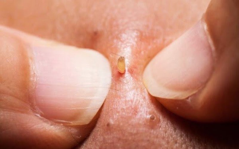 Nặn mụn đầu đen