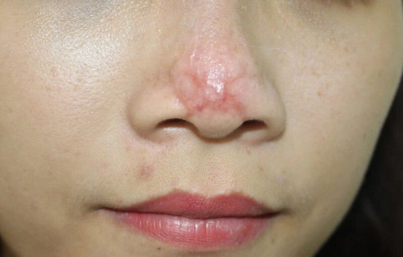 Mũi bị đỏ sau khi tiêm filler