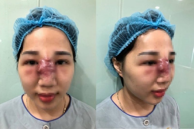 Hình ảnh mũi của khách hàng bị biến chứng sau khi tiêm filler.