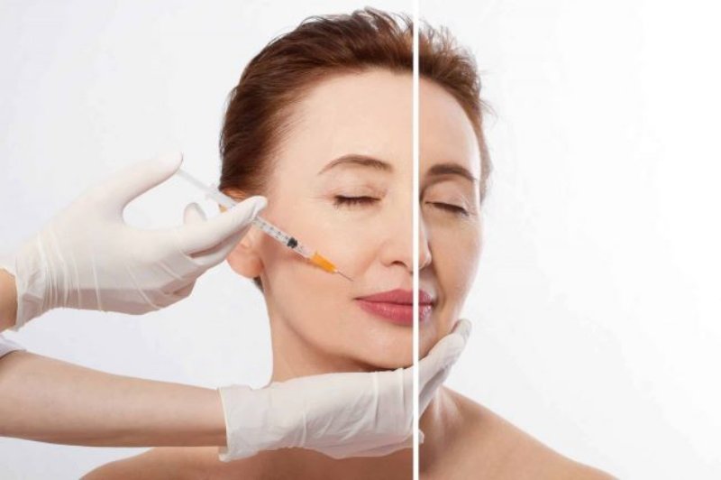 Việc tiêm filler đôi khi cũng gây ra hiện tượng chảy xệ, tuy nhiên không phải ai cũng gặp phải. 